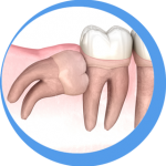 Extraction-complexe-Extraction-Dentaire-clinique-dentaire-Targa