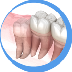 Extraction-simple-Extraction-Dentaire-clinique-dentaire-Targa