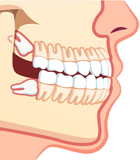 Extractions-de-dents-de-sagesse-Extraction-Dentaire-clinique-dentaire-Targa