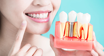 implant-dentaire