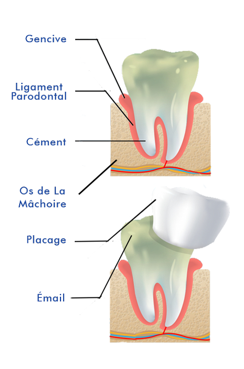 mobile-schéma-facette-dentaire