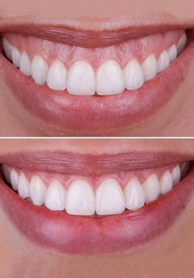 section 1 gingivectomie image