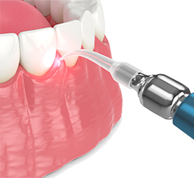section-2-gingivectomie-cdt