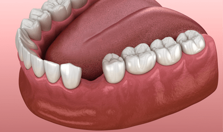 dent-absente-section-1-min