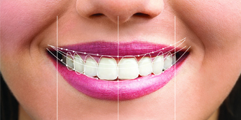 imperfection-du-sourire-section-2