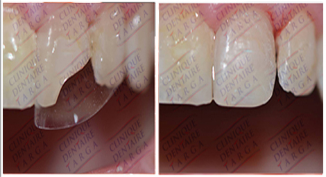 section-2-dents-casses